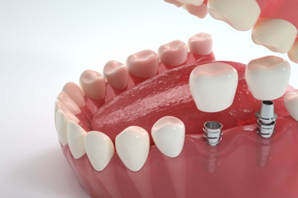 Dental Implants in Northeast Philadelphia for Long Lasting Natural Looking Smiles - image 1