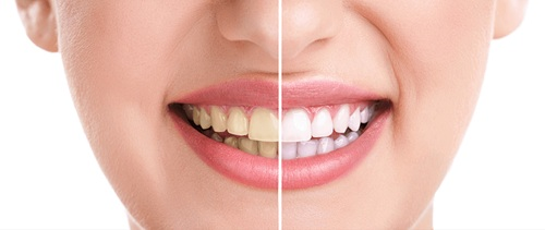 Professional Teeth Whitening Philly Services Helping Patients Achieve Brighter Confident Smiles - image 1