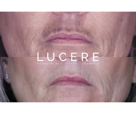 PicoSure Laser Brightening - image 1