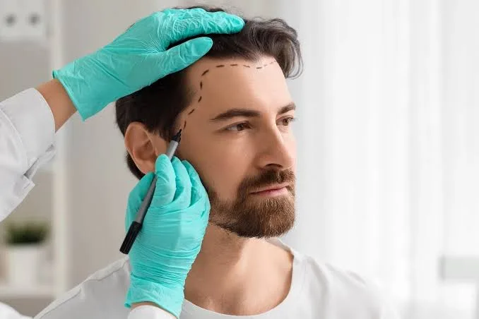 Best Hair Transplant Clinic in Turkey – Dr. Haror’s Wellness - image 1