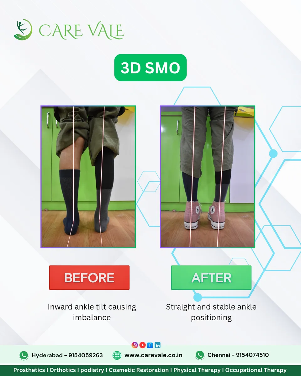 Best Artificial Leg in Hyderabad | CareVale Prosthetics - image 1