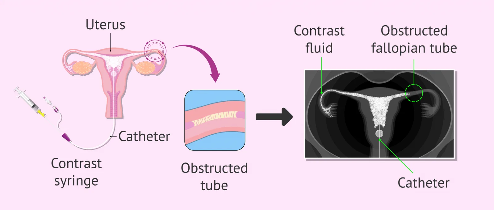 Hysterosalpingography in Delhi – Fertylity IVF Expert Care - image 1