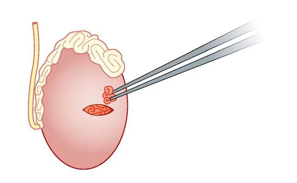 MicroTESE in Delhi for Male Infertility | Fertylity IVF - image 1