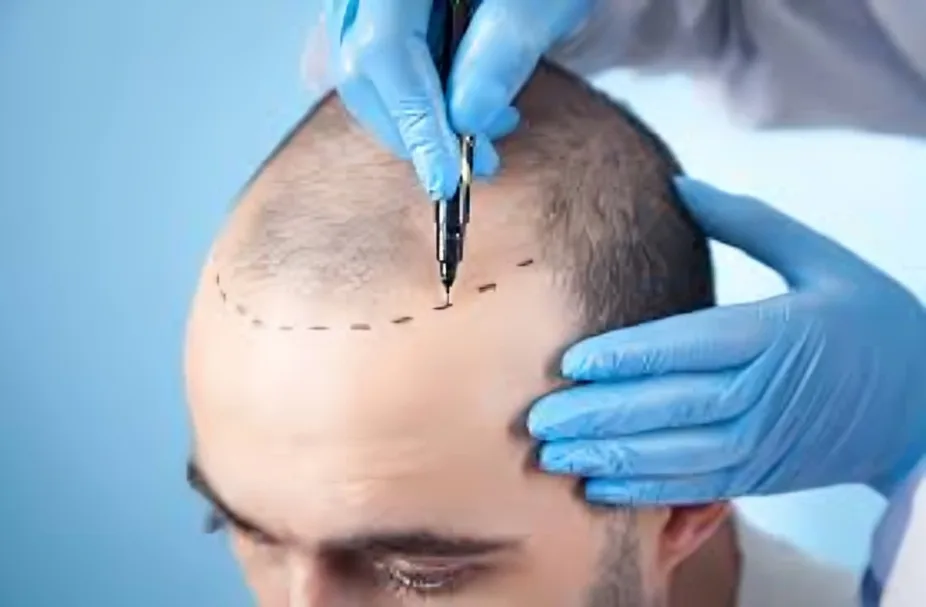 Put Your Hair in the Hands of Delhi's Finest Hair Transplant Surgeon - image 1