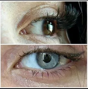 How To Lighten Eye Color: Available Options - image 1