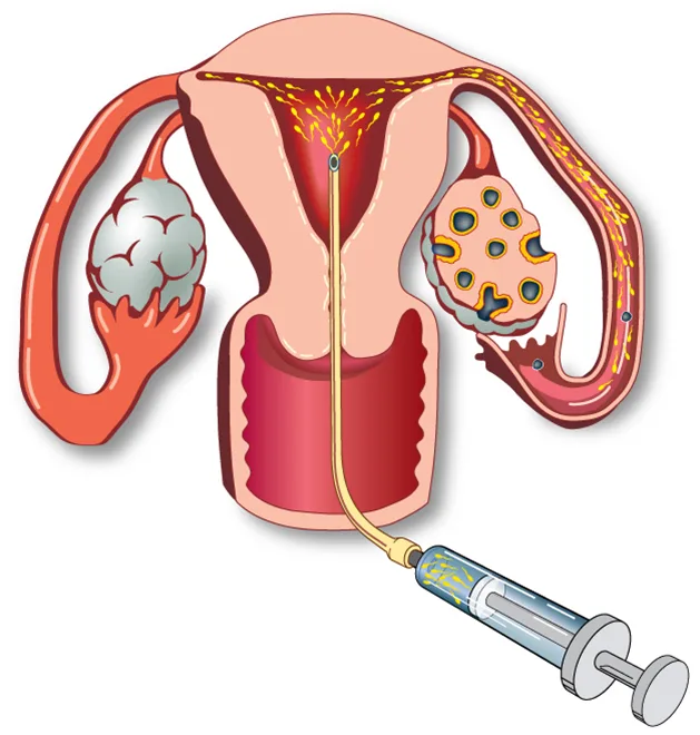 Trusted Intrauterine Insemination in Delhi at Fertylity IVF - image 1