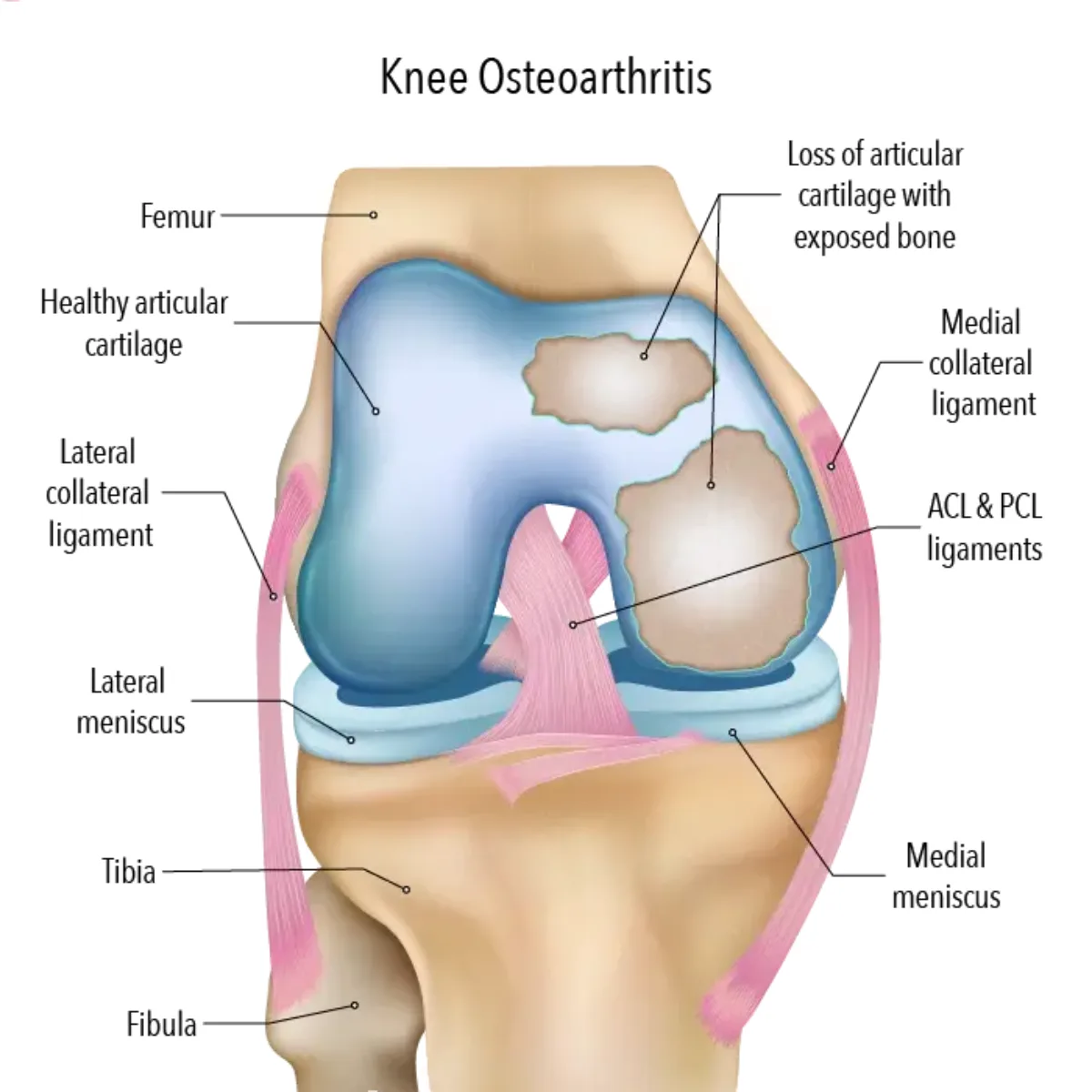 Improve Knee Function with Partial Knee Arthroplasty - image 1