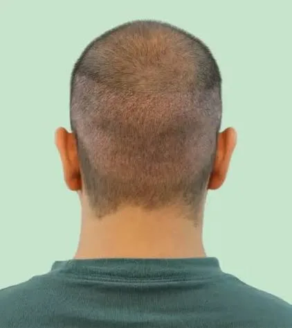 Consult the Best Hair Transplant Surgeon in Delhi, India - image 1