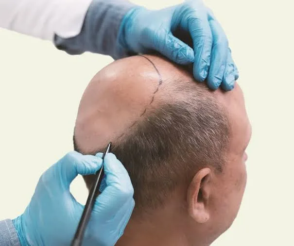Thin Hair? Not Anymore — India's Most Effective Hair Thinning Treatments - image 1