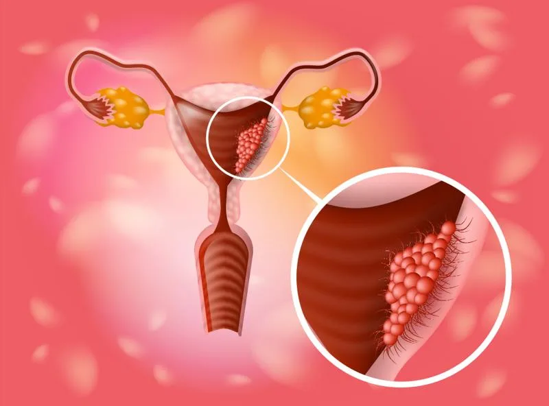 Best Care for Uterine Cancer Treatment in Noida by Specialists' - image 1