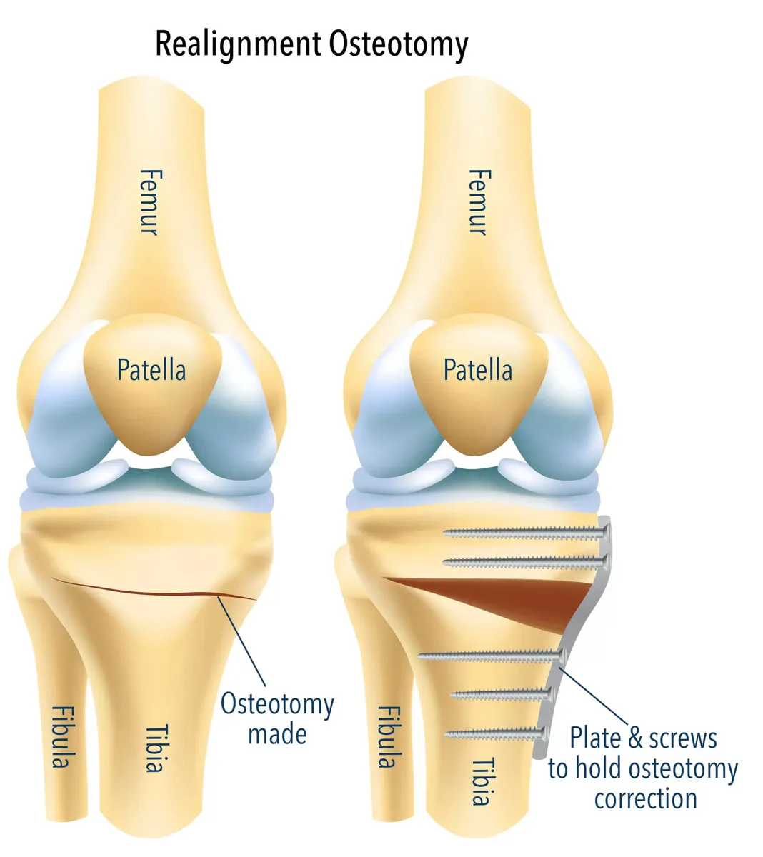 Protect Your Knee with Osteotomy Surgery - image 1